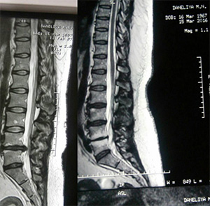 Tratamentul herniei spinale fără intervenție chirurgicală - Centrul de kinetoterapie din Kazan