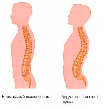 Tratamentul lordozelor coloanei vertebrale cervicale și lombare