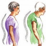 Лікування остеопорозу у жінок похилого віку огляд засобів