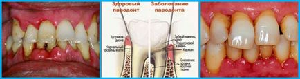 Tratamentul parodontitei la domiciliu decât poate fi tratat cu dinți parodontali