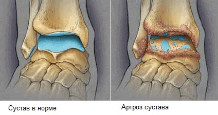 Tratamentul artrozei posttraumatice a terapiilor articulațiilor glezne, remedii folclorice