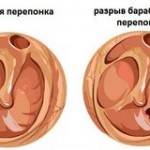 Tratamentul tinitusului la domiciliu Prezentare generală a prescripțiilor