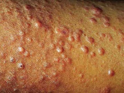 Leprosy simptome, semne, prevenire