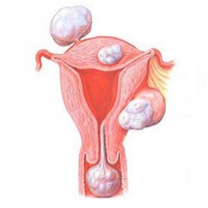 Leiomyomul uterului ceea ce este, tipurile și simptomele, tratamentul sau îndepărtarea