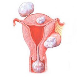 Лейоміома матки що це таке, типи і симптоми, лікування або видалення