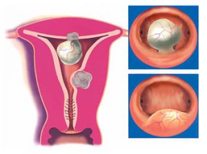 Leiomyomul uterului ceea ce este, tipurile și simptomele, tratamentul sau îndepărtarea