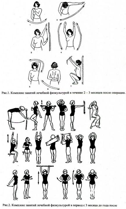 Lymphostasis (limfedem) la cancerul mamar, tratamentul pe bază de plante, gimnastica pentru limfostazie, oncologie