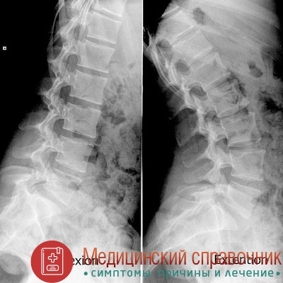 Лордоз поперекового і шийного відділів хребта - симптоми, лікування, вправи