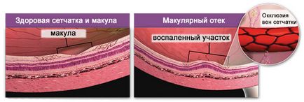 Макулярної набряк сітківки ока - лікування, симптоми і причини