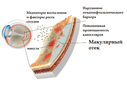 Макулярної набряк сітківки ока - лікування, симптоми і причини