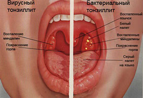 Clinica medicală cryo - miere - amigdalită