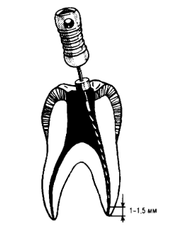 Tehnica de prelucrare instrumentală a canalelor radiculare este un bun portal dentar, bun