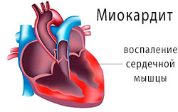 Myocarditis tünetek, kezelés, okok, diagnosztikai, szövődmények megelőzése