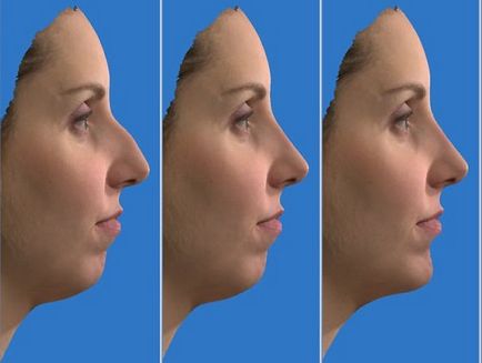 Modelarea nasului inainte de fotografii, video, programe de rinoplastie