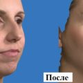 Modelarea nasului inainte de fotografii, video, programe de rinoplastie