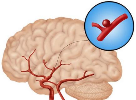 Мр-ангіографія судин головного мозку та шиї