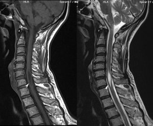 Mersul coloanei vertebrale și măduva spinării, docclinice