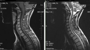 Mersul coloanei vertebrale și măduva spinării, docclinice