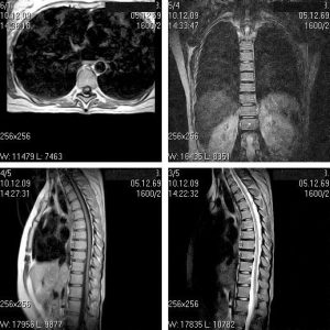 Mersul coloanei vertebrale și măduva spinării, docclinice