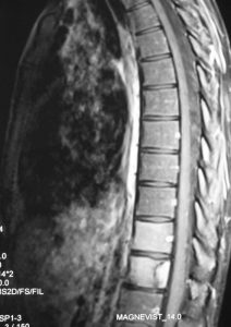 Mersul coloanei vertebrale și măduva spinării, docclinice