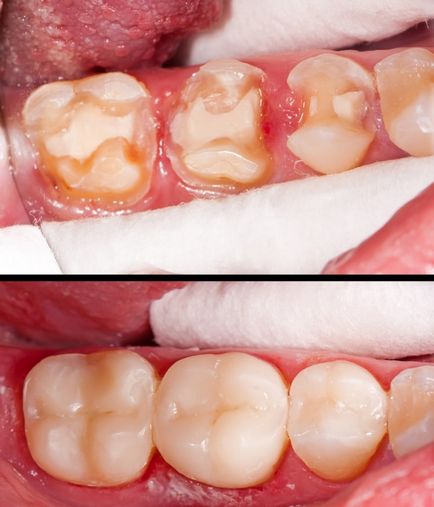 Extinderea dinților, înainte și după - fotografii cu exemple
