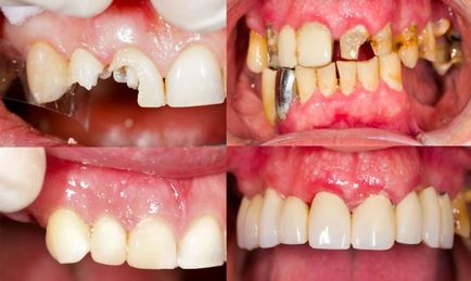 Extinderea dinților, înainte și după - fotografii cu exemple