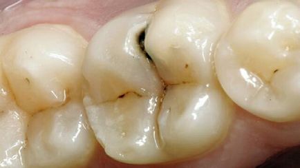 Az öröklődés és a fogszuvasodás - caries-e öröklött - Dental portálon (AChE tömítés után) Az öröklődés és a fogszuvasodás - fogszuvasodás, ha örökölt - Fogászati portál