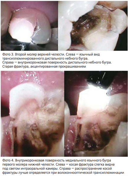 Fractiile incomplete ale diagnosticului precoce al colibelor, utilizarea transilluminării cu fibre optice și