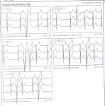 Nu se oprește aritmia-inima ca și cum ar fi comprimată - cardiologul întrebării - 03 online