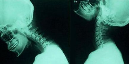 Instabilitatea coloanei vertebrale cervicale la copii - semne, simptome și tratament