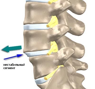 Instabilitatea coloanei vertebrale cervicale la adulți, copii, simptome, cum se tratează
