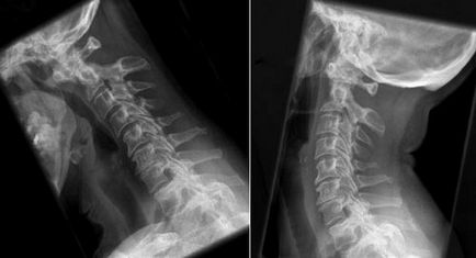 Instabilitatea coloanei vertebrale cervicale la adulți, copii, simptome, cum se tratează