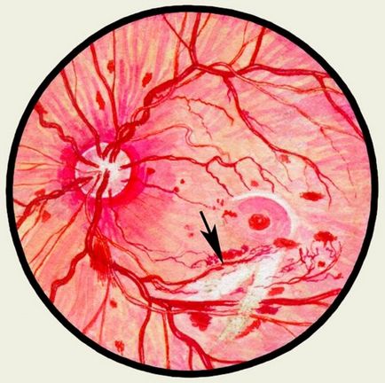 Nevrită optică - cauze, simptome și tratament, site-ul medical