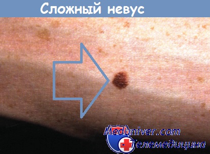 Nevus complex (mixt) - clinică, diagnostic, prognostic