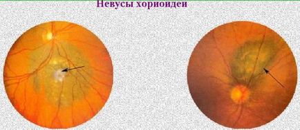 Nevus Choroidal Eye Symptoms, cauze și tratament