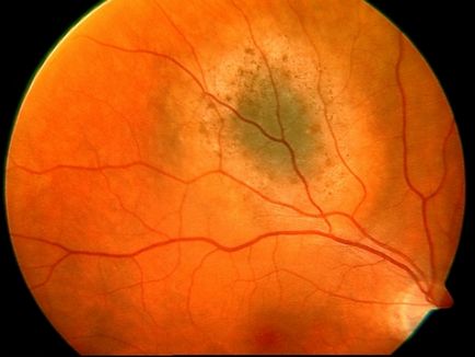 Nevus Choroidal Eye Symptoms, cauze și tratament