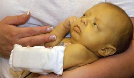 Norma bilirubinei la nou-născuți este icterul, diagnosticul și tratamentul