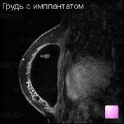 emlővizsgálat implantátumok - blog omorfia projekt