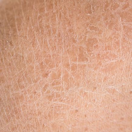 Дуже суха шкіра шукаємо причину в харчуванні, способі життя і гормонах