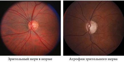 Oftalmologia nervului optic congestiv