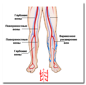 elzáródásos DVT