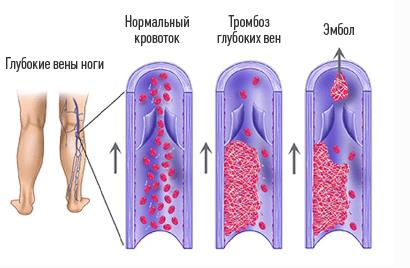 Оклюзійний тромбоз глибоких вен