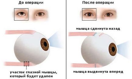 Funcționarea asupra metodelor strabismului de chirurgie inovatoare