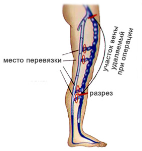 Операция на разширени вени на краката - какво да избират и какво да очакват - разширени вени