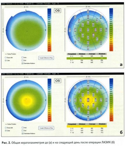 Tomografia coerenței optice