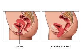 Omiterea cauzelor uterului, simptome, diagnostic, chirurgie