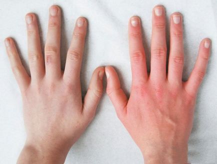 Palmele mâinilor cauzei au crescut, diagnosticul tulburărilor, tipurile de ajutor
