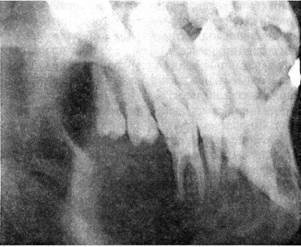 Daganatok a pofák eosinophil granuloma