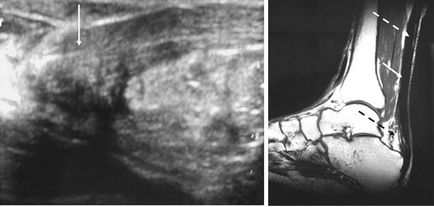 Caracteristicile diagnosticului ruperii cronice a tendonului lui Ahile