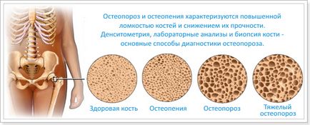 Остеопороз і симптоми і лікування у дорослих і дітей